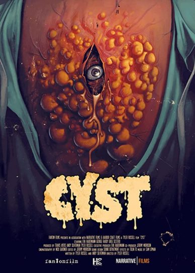 Cyst